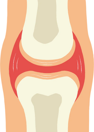 Illustration of a knee joint showing bone structure and cartilage